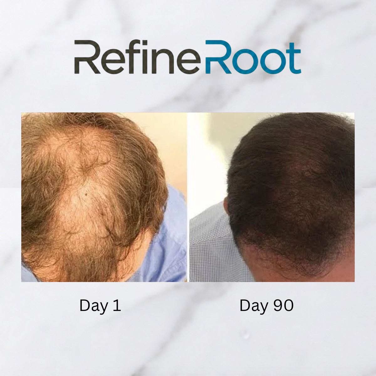 RefineRoot™ Scalp Renewal Kit