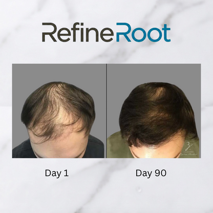 RefineRoot™ Scalp Renewal Kit